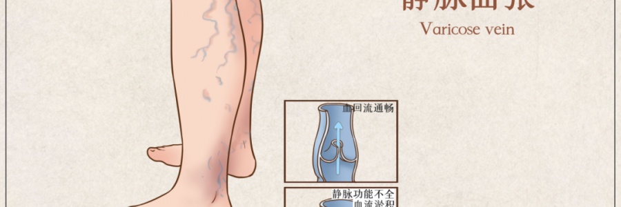 告別“蚯蚓腿”，靜脈曲張怎么調(diào)？