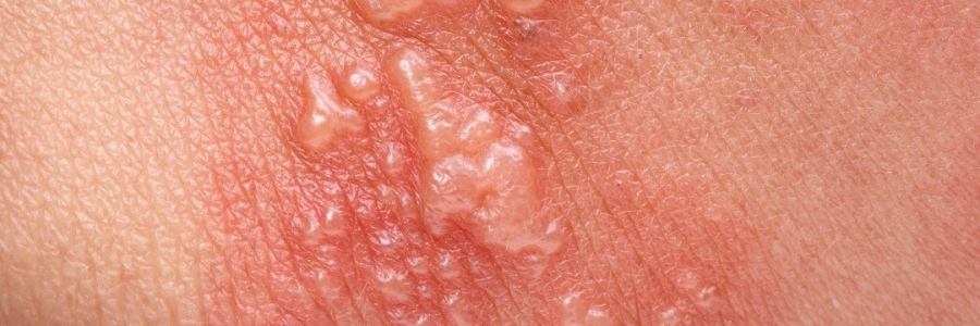 艾灸后起了小水泡，居然是邪氣在“逃跑”！