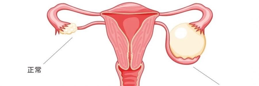 太神奇了，艾灸調(diào)好了她的卵巢囊腫！